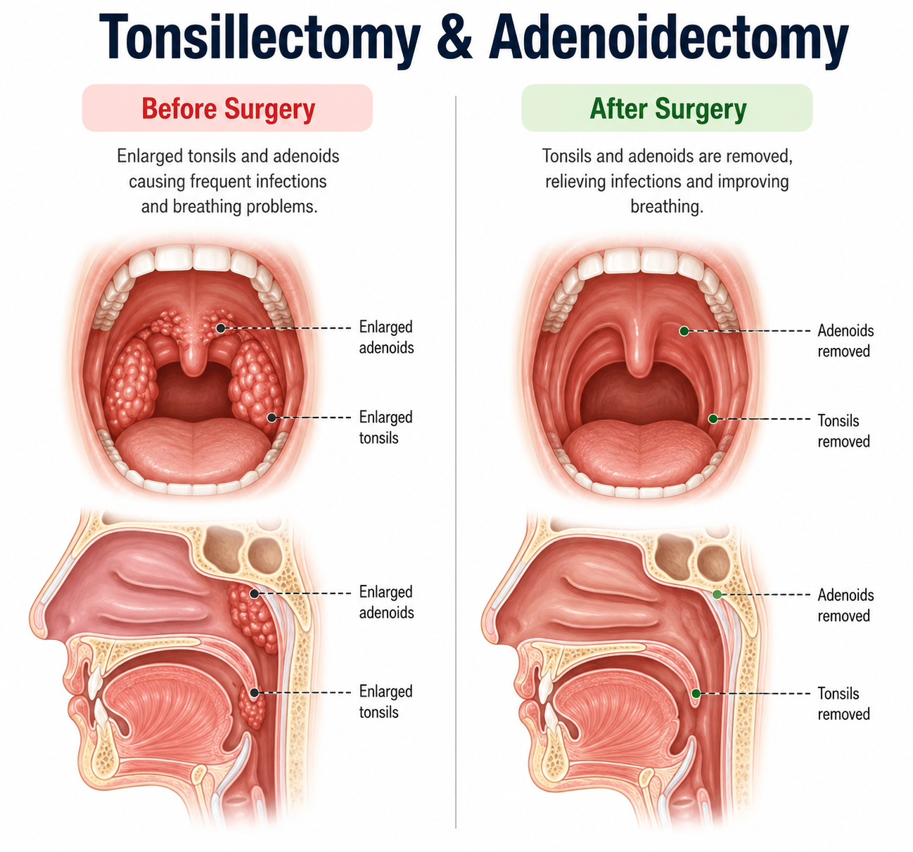 Tonsillectomy & Adenoidectomy — anatomy diagram